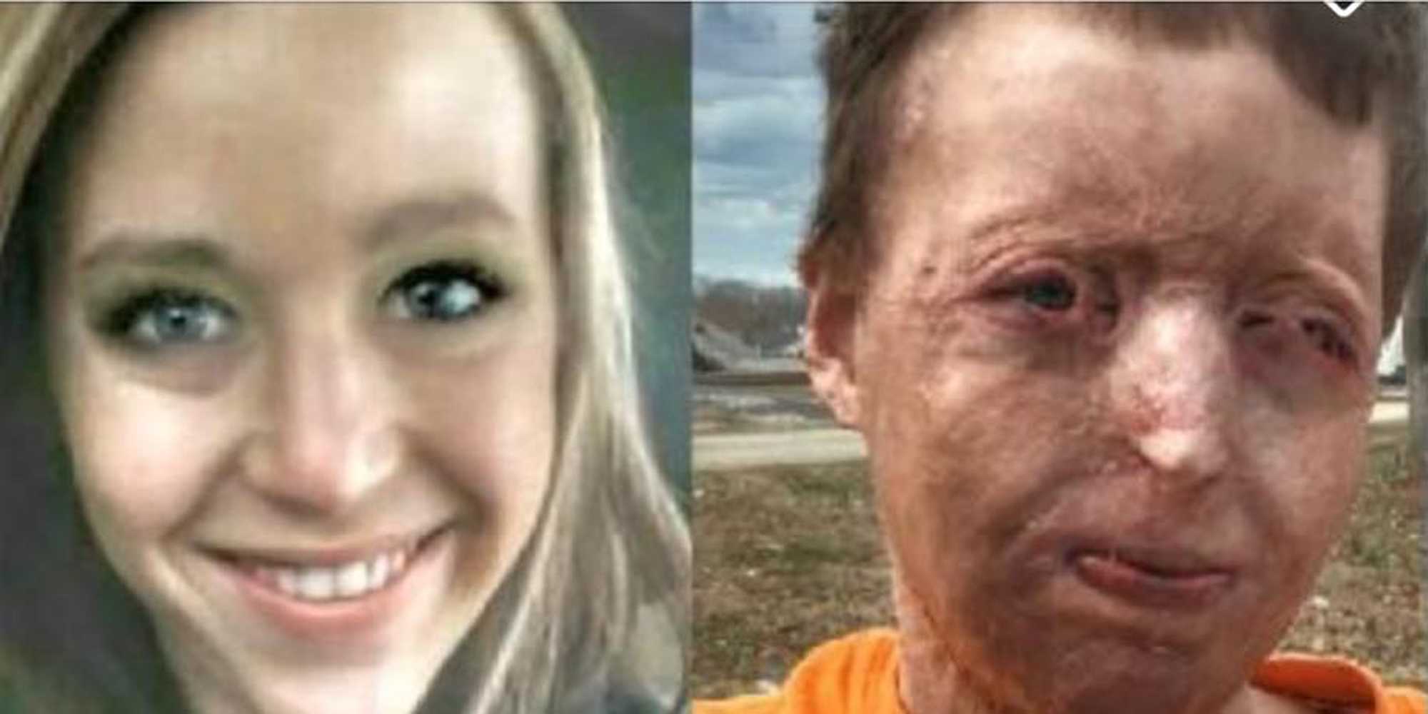 Mom disfigured by campfire accident and then abandoned by husband speaks out