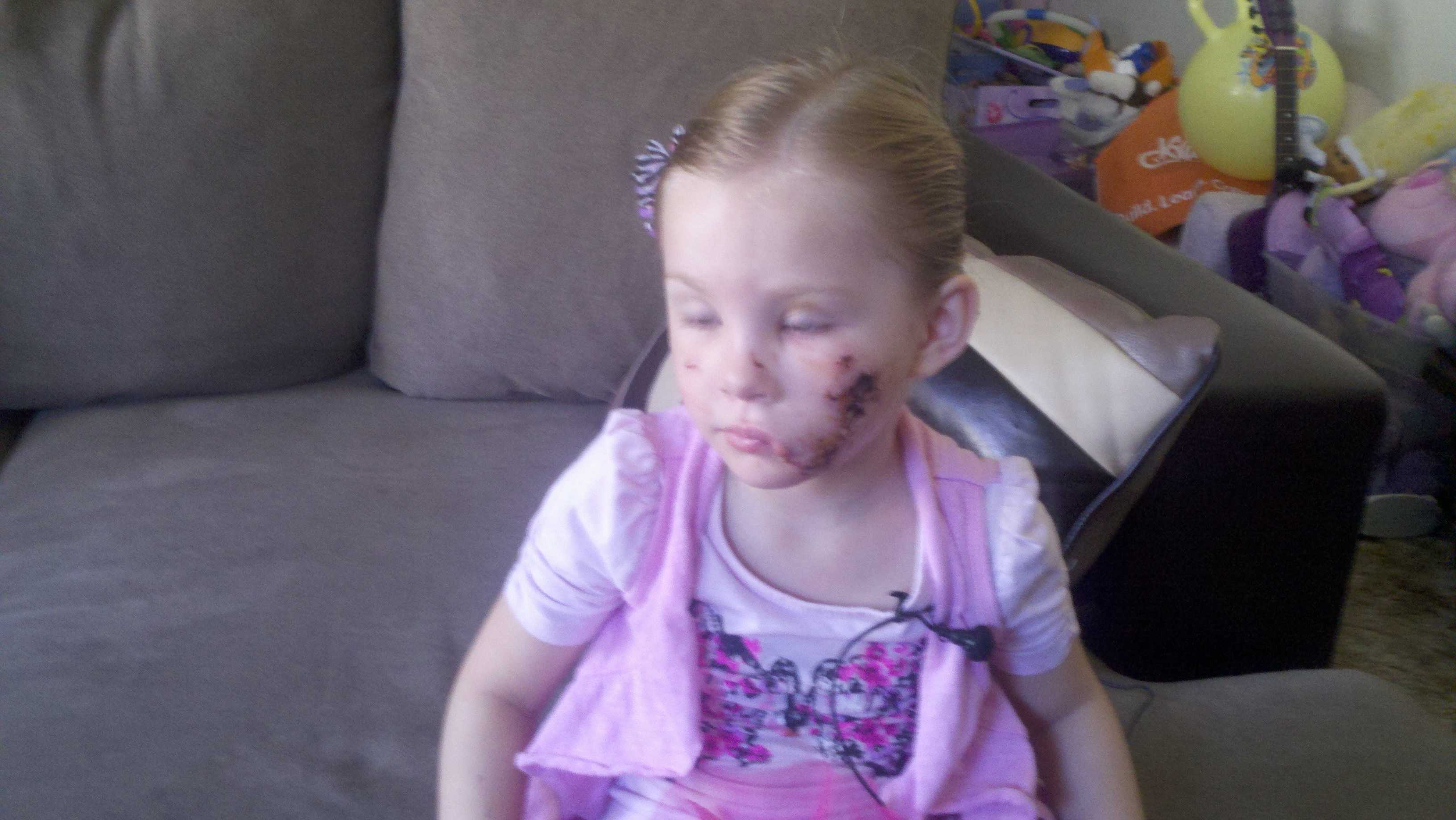 Photos: Girl Recovers From Pit Bull Attack