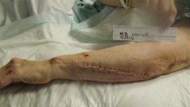 doctors treat 6 in omaha for flesh eating bacteria flesh eating bacteria pictures