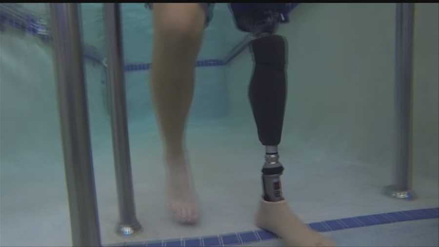 Life after leg amputation picture