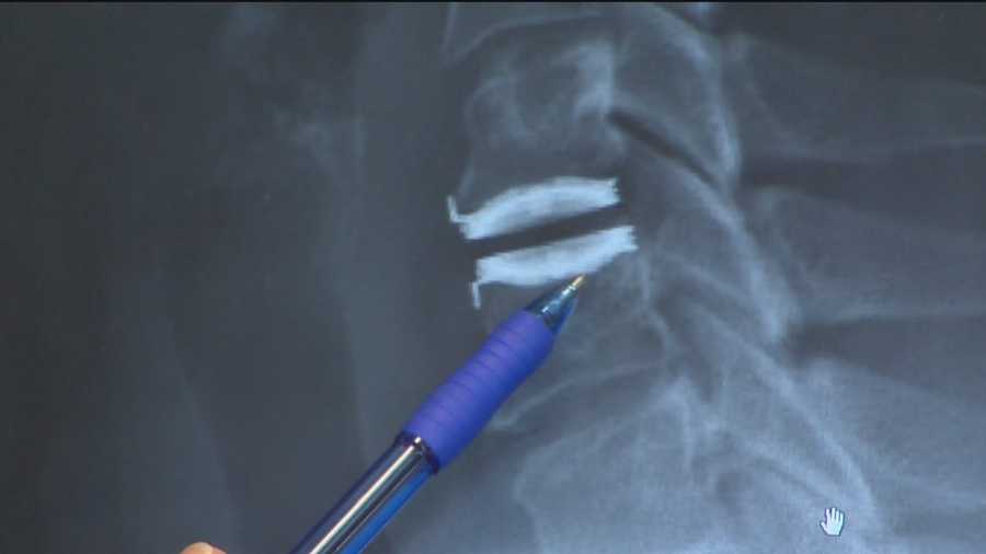 Surgery helps fix disc, nerve problems in neck