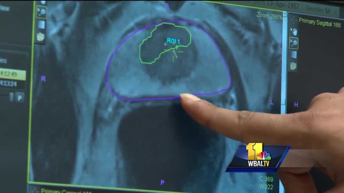 New Biopsy Detects Prostate Cancer