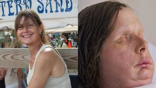 woman face transplant after chimpanzee attack