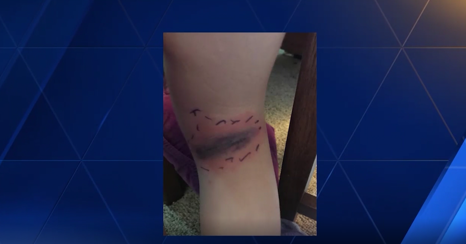 Black widow spider bite sends girl to hospital - Kansas news - NewsLocker