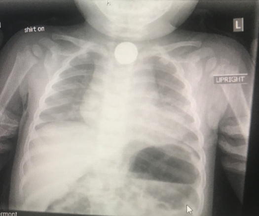Baby boy nearly dies after swallowing button battery