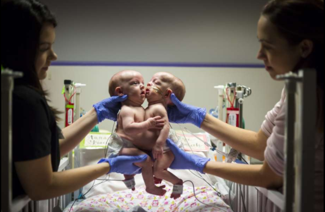 Conjoined twin girls separated in seven-hour surgery