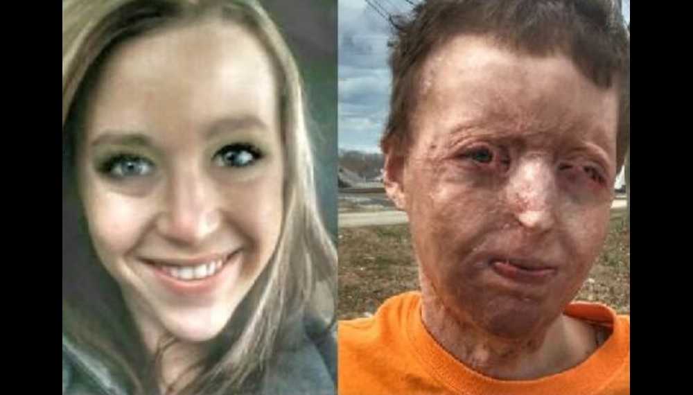 Donations pour in for young mother horrifically burned, then abandoned by husband