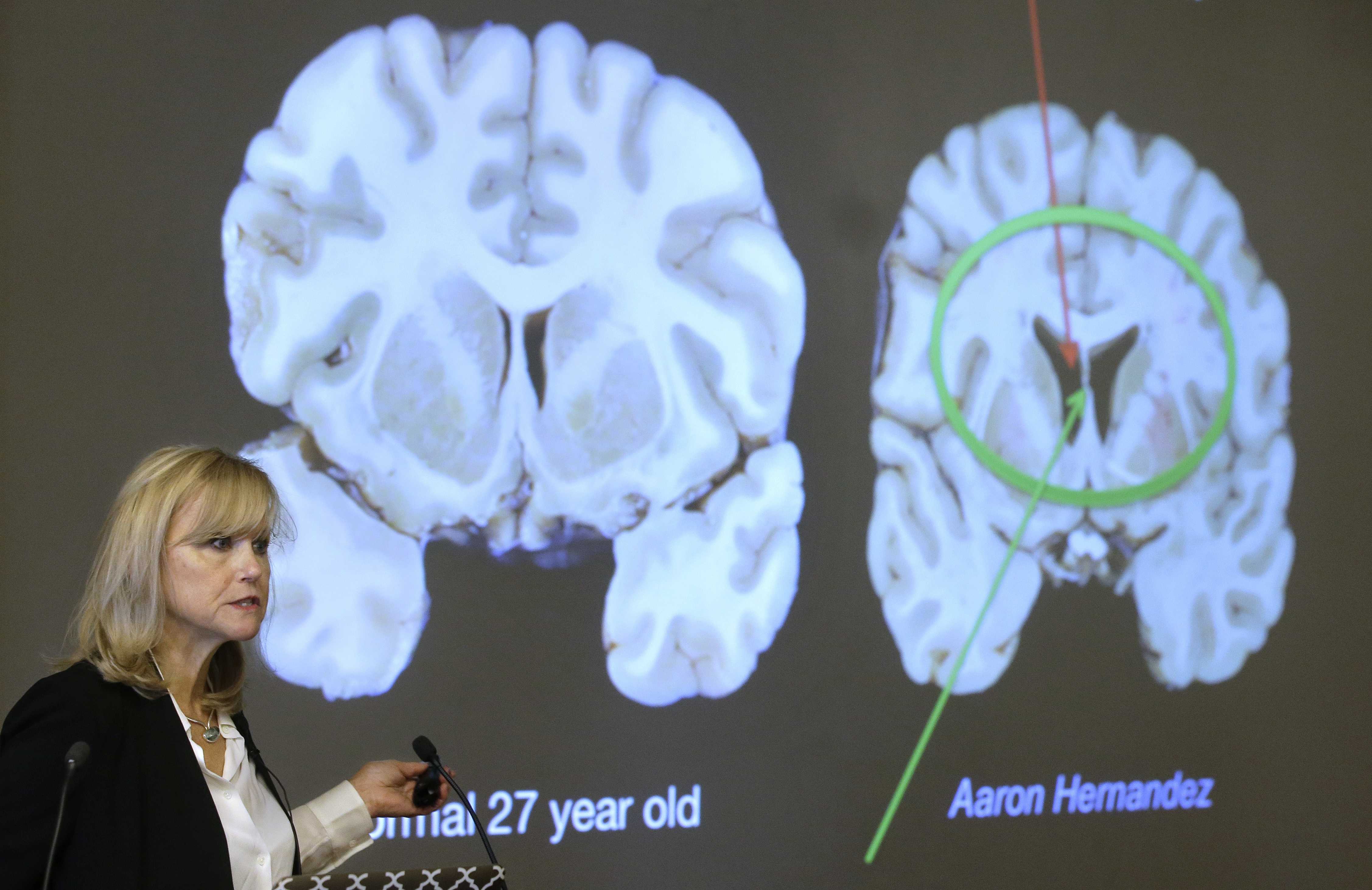 Repeated hits, not concussions, cause CTE, study finds