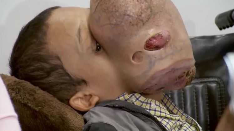 Boy dies after surgery to remove 10-pound tumor from face