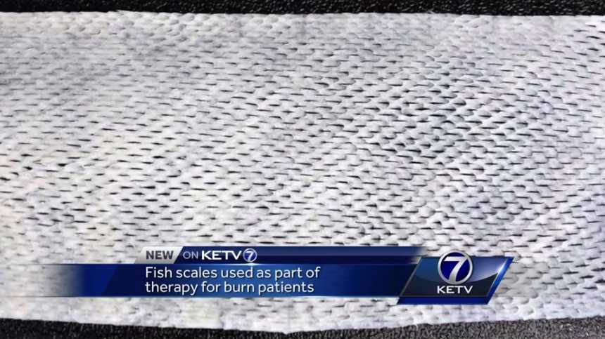 Fish scales used as part of therapy for burn patients