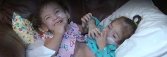 Conjoined twins celebrate first birthday since separation