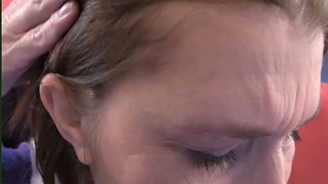 Woman gets life-changing migraine surgery
