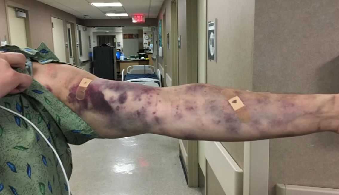 No one is sure what mystery insect bit this man's arm