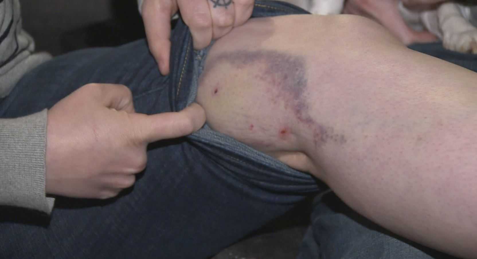 Woman says she was bitten by emotional support dog in JetBlue check-in line