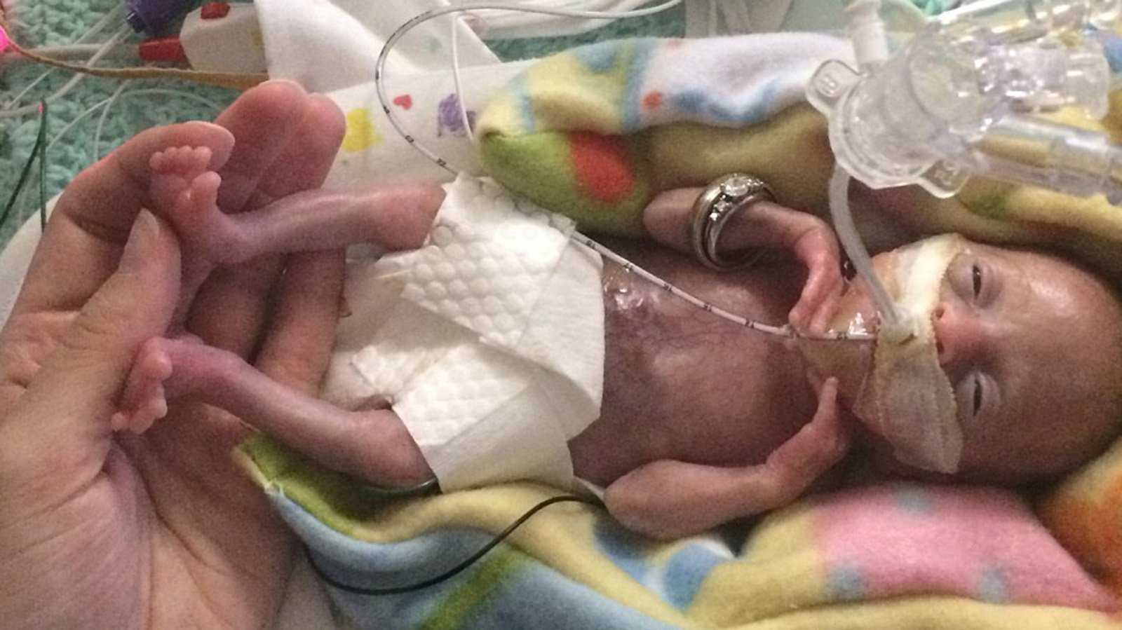 Born before 22 weeks, 'most premature' baby is now thriving