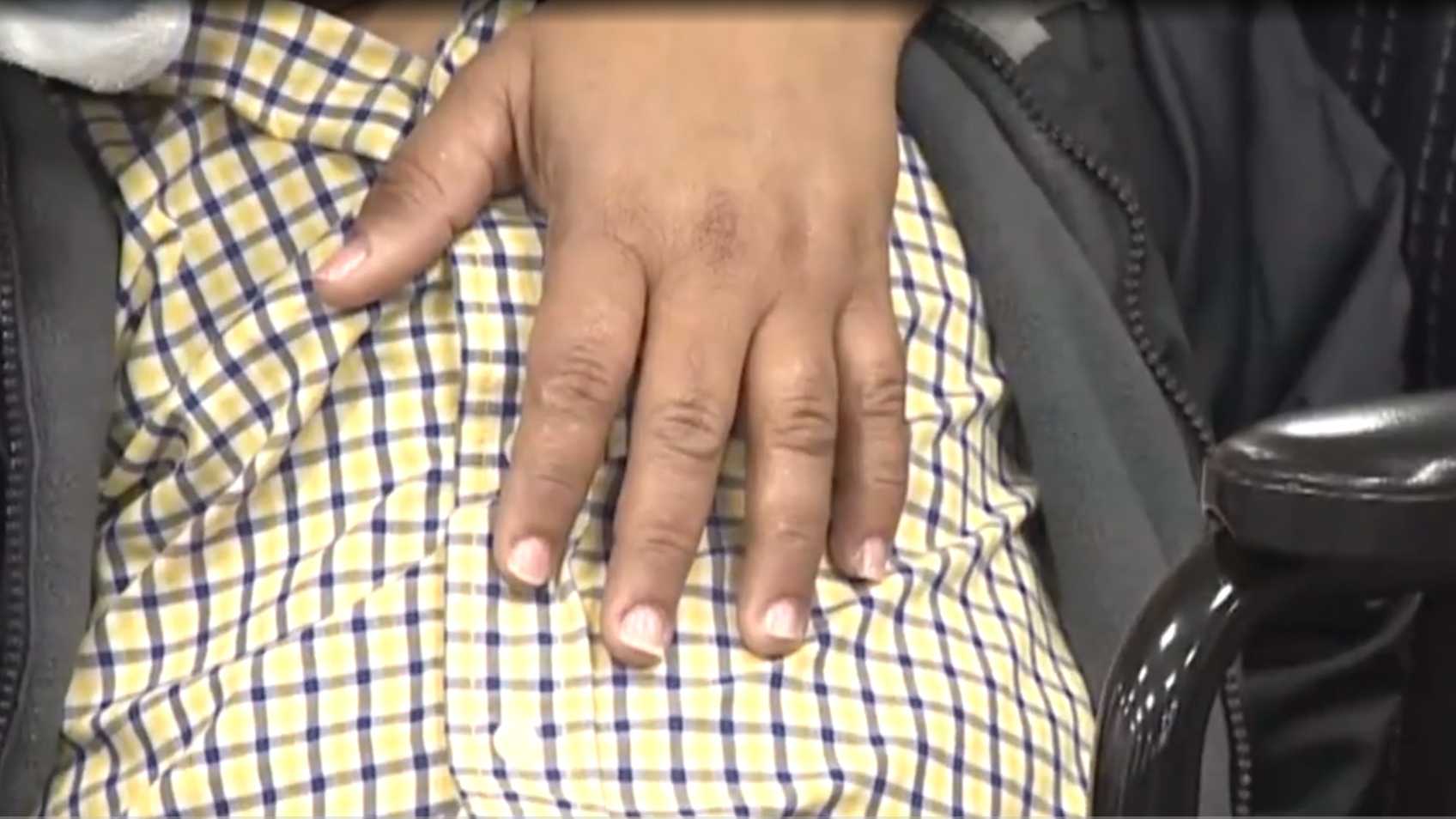 Boy dies after surgery to remove 10-pound tumor from face