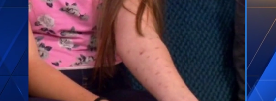 Dangerous 'Deodorant Challenge' burns skin, may cause infection