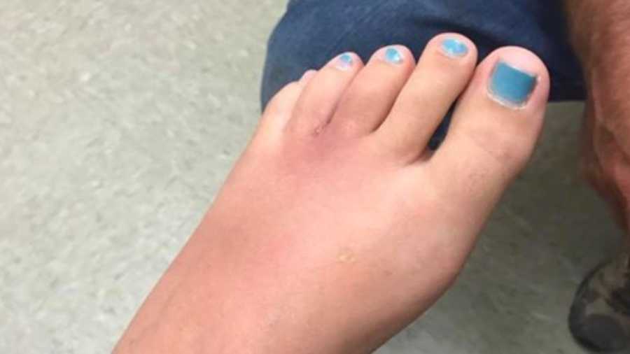 3 cases of flesh-eating bacteria confirmed in Mississippi, Alabama