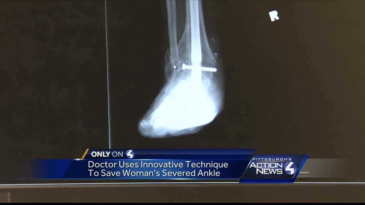 Doctor uses innovative technique to save woman's severed ankle