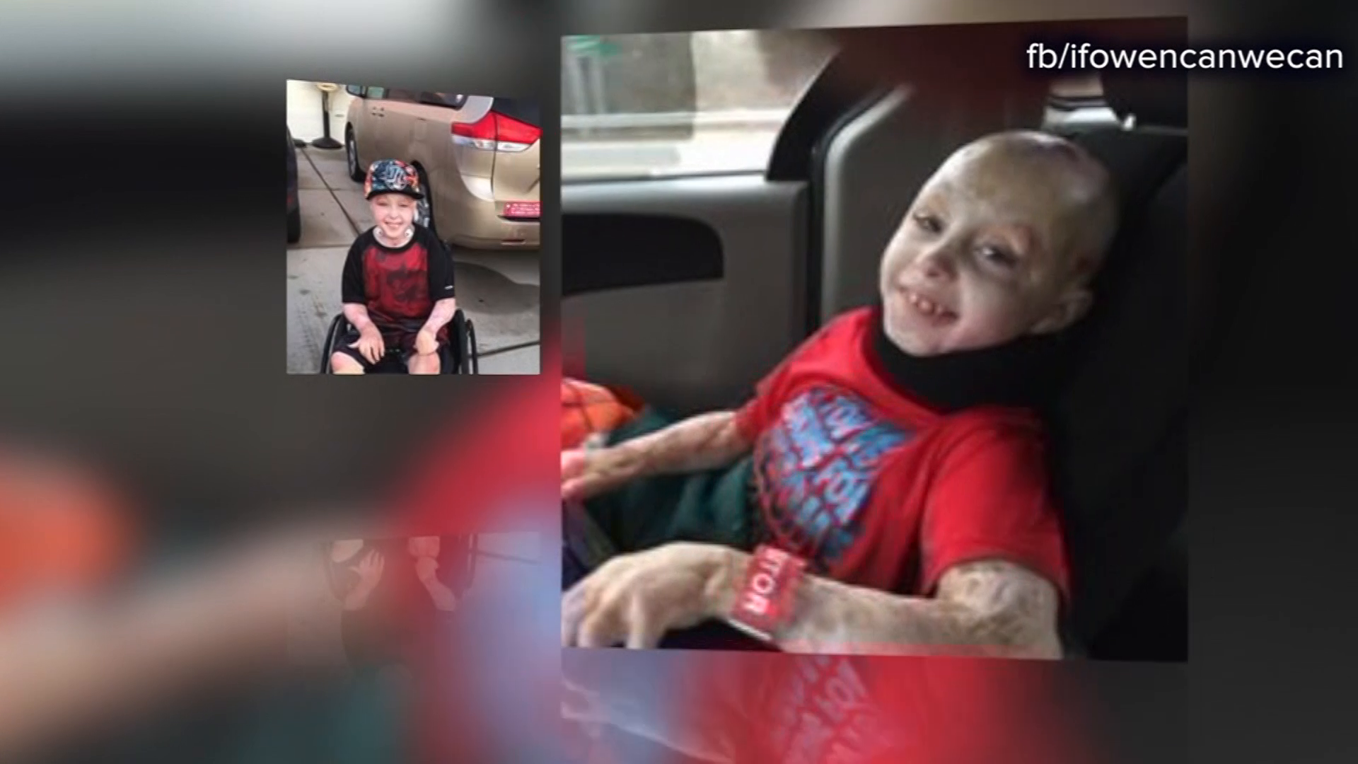 Double amputee to meet quadruple-amputee therapy dog