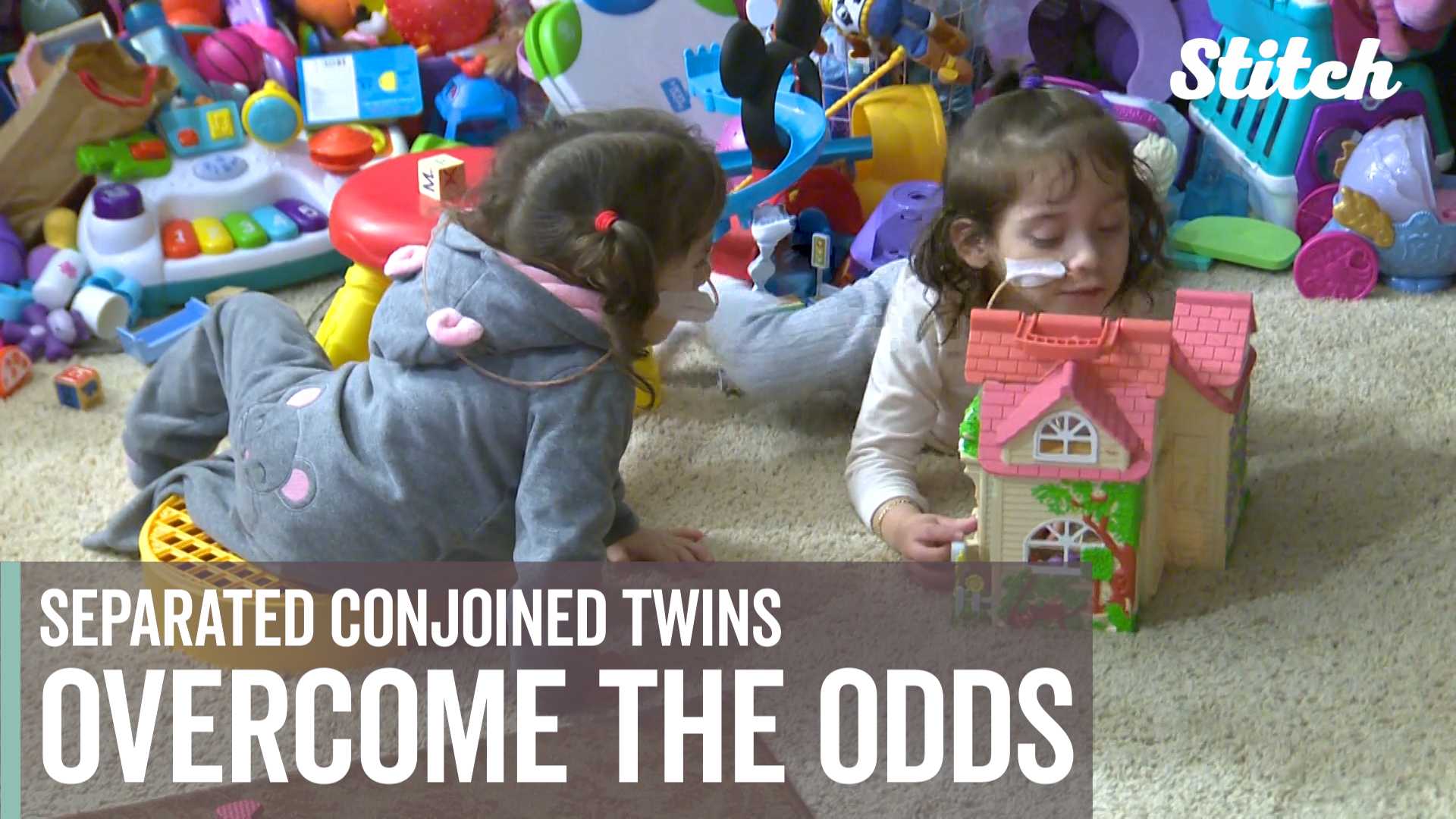 Separated conjoined twins overcome the odds