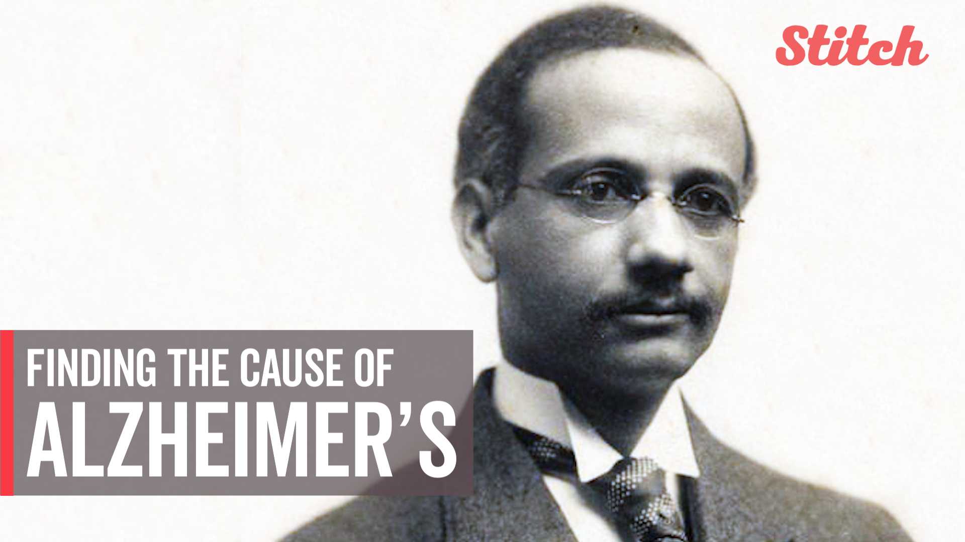 Dr. Solomon Carter Fuller discovered the cause of Alzheimer's disease