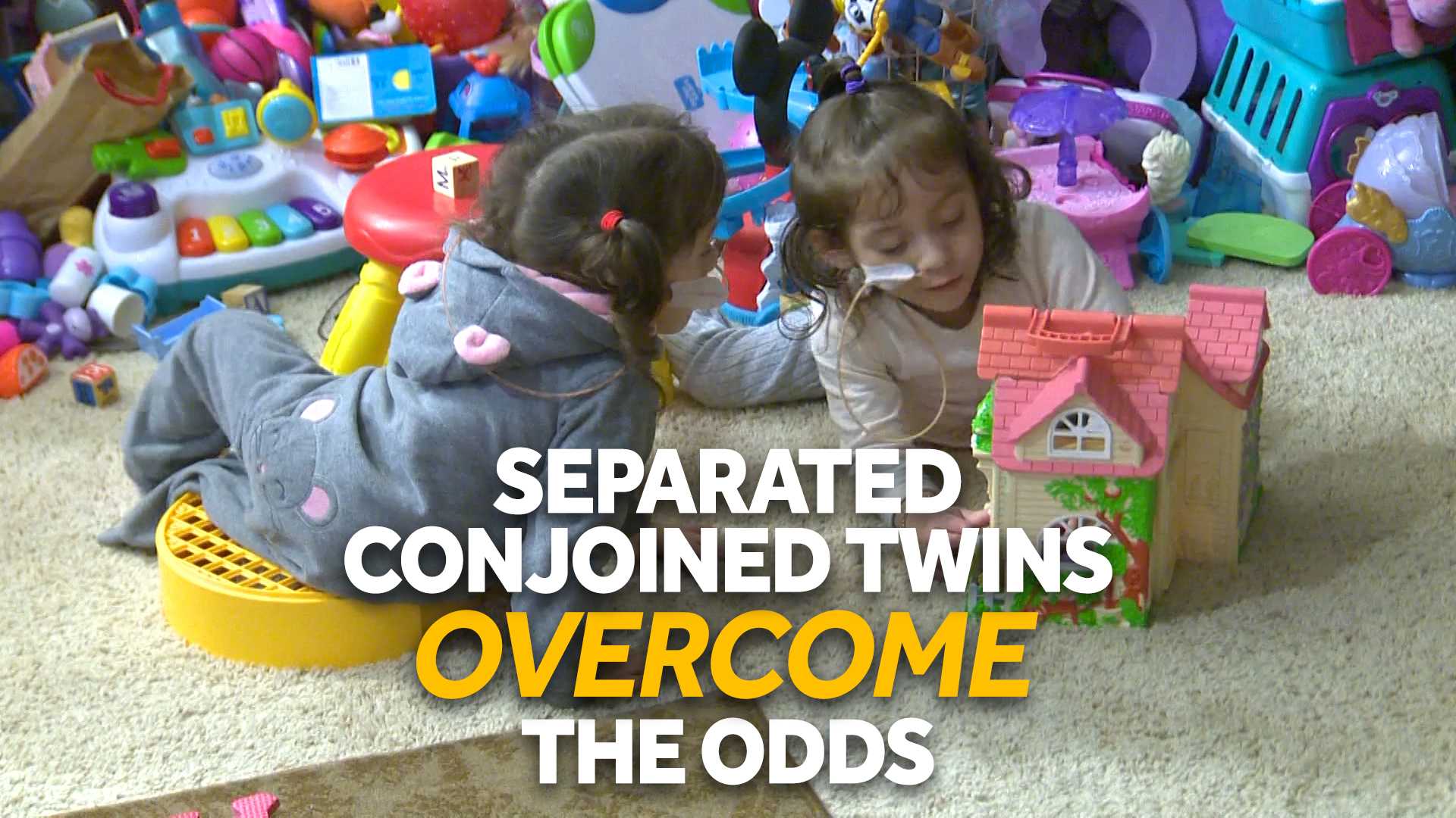 Conjoined twins separated by doctors overcome the odds